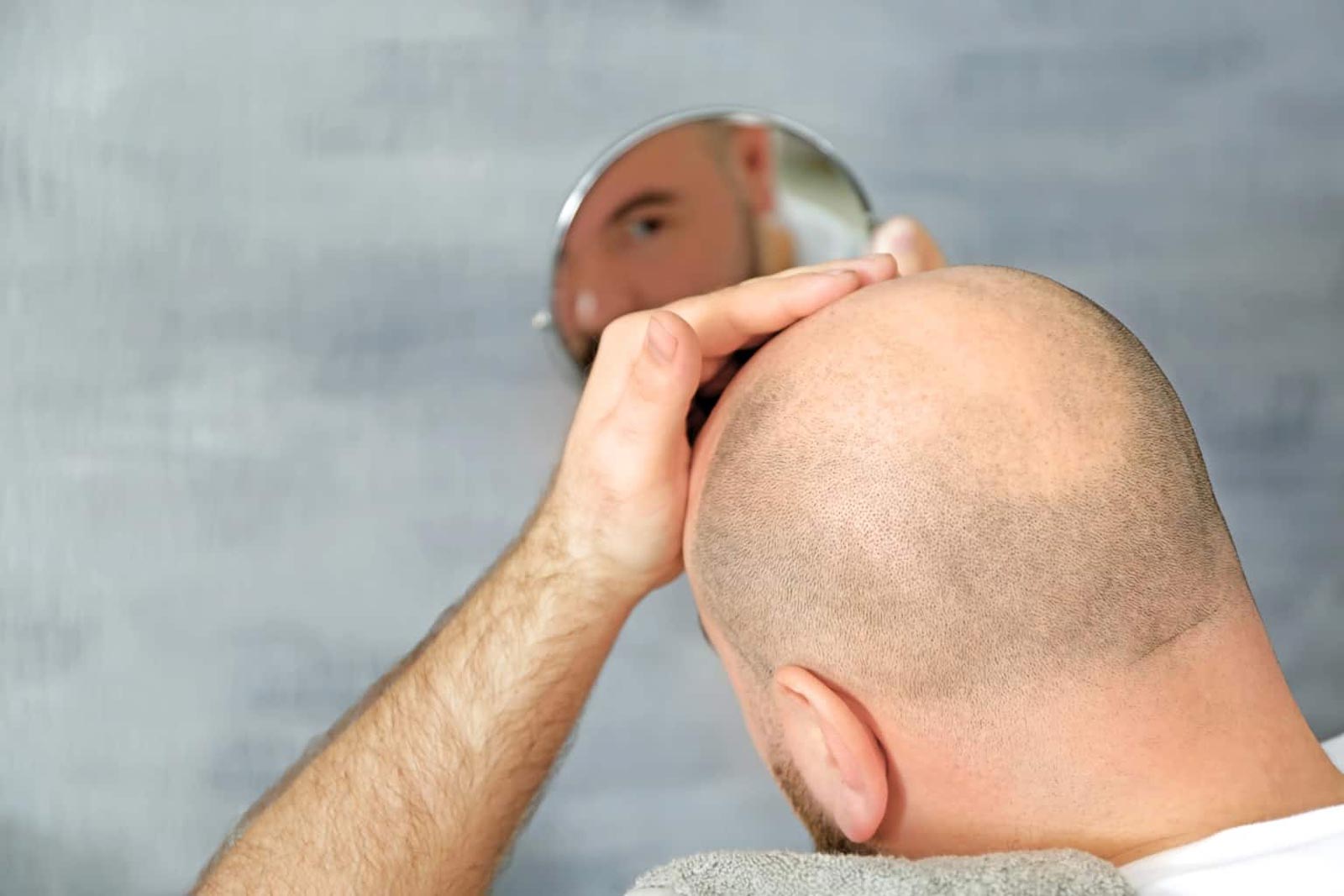 What are the Different Techniques and Methods of Hair Transplant?