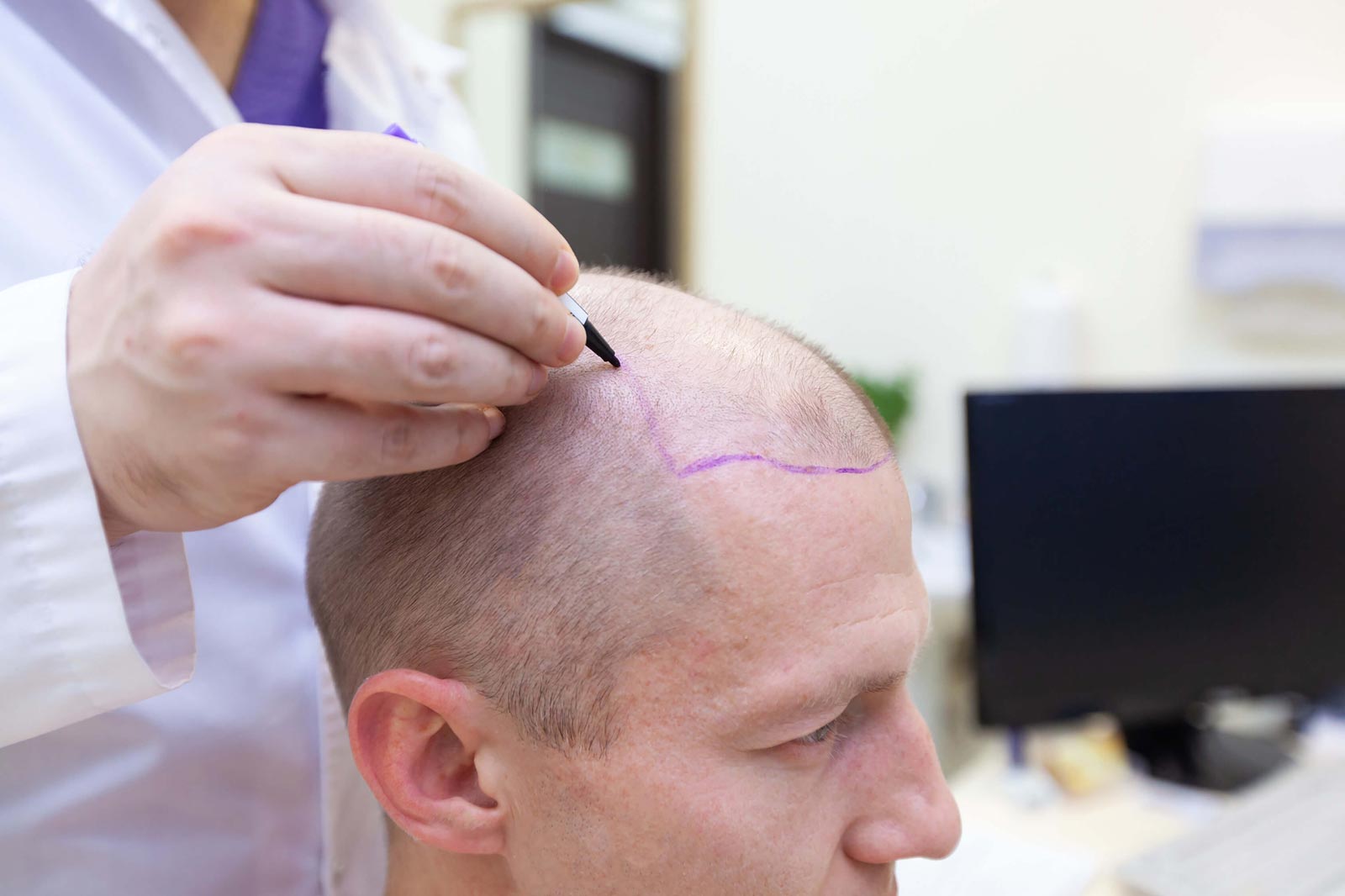 What are the Advantages and Disadvantages of Hair Transplant?